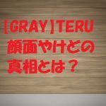 TERU顔面やけどの理由と真相とは?いつライブ復帰できる?後遺症はある?
